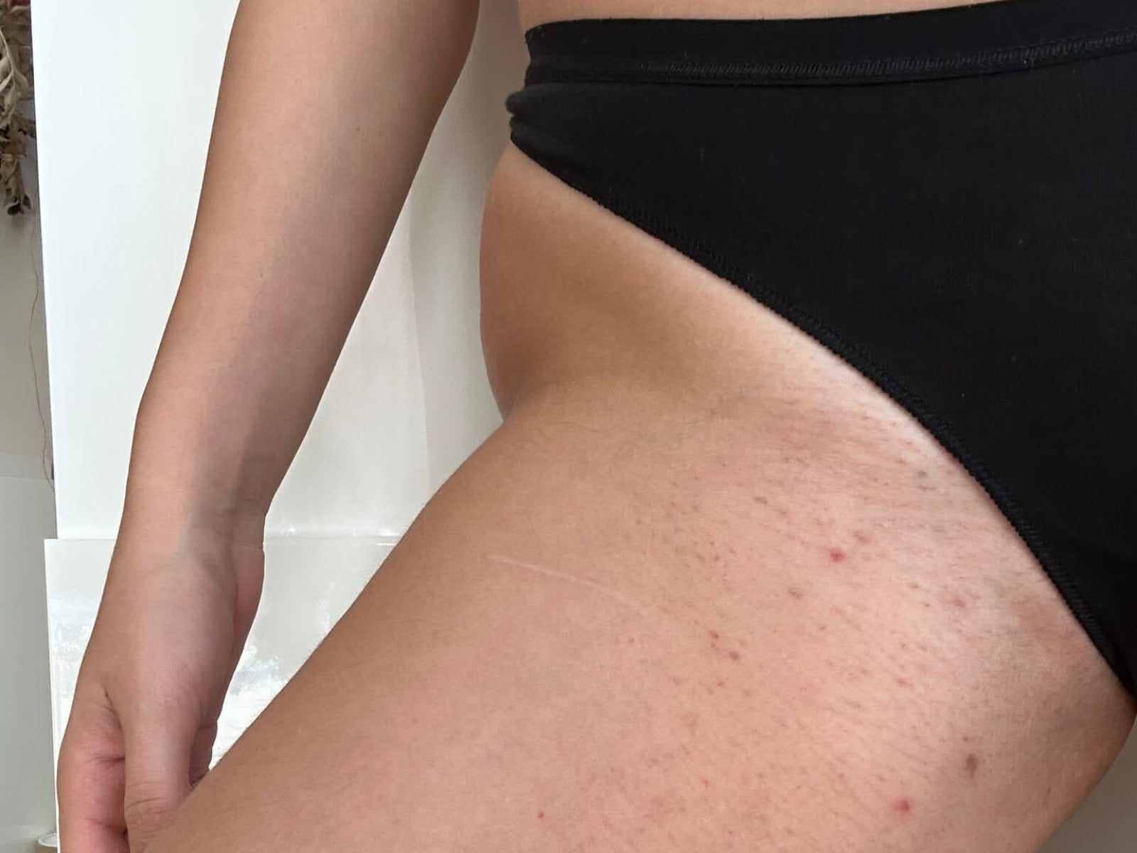Folliculitis and Ingrown Hairs: How to Say Them Goodbye Forever